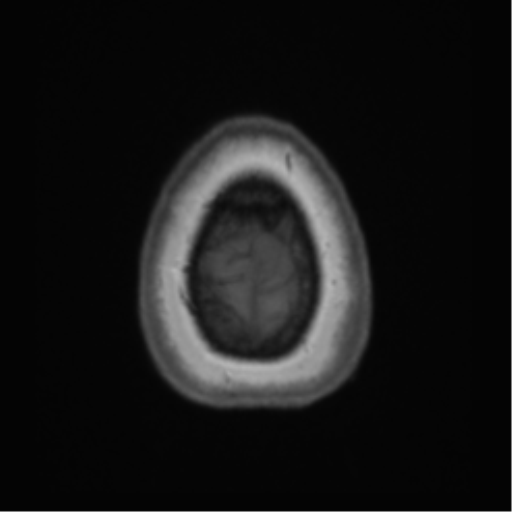 Anaplastic oligodendroglioma (Radiopaedia 83500-98599 Axial T1 72).png