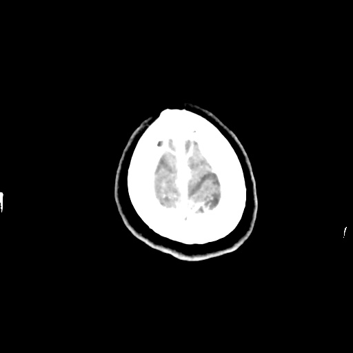 Aneursym related subarachnoid hemorrhage with hydrocephalus (Radiopaedia 45105-49084 D 52).jpg