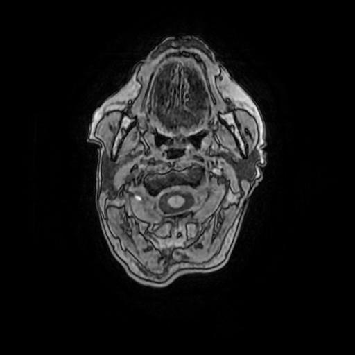 Aneurysm of the terminal internal carotid artery (Radiopaedia 88167-104764 Axial T1 11).jpg