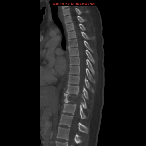 File:Aneurysmal bone cyst (Radiopaedia 9419-10102 Sagittal bone window 8).jpg