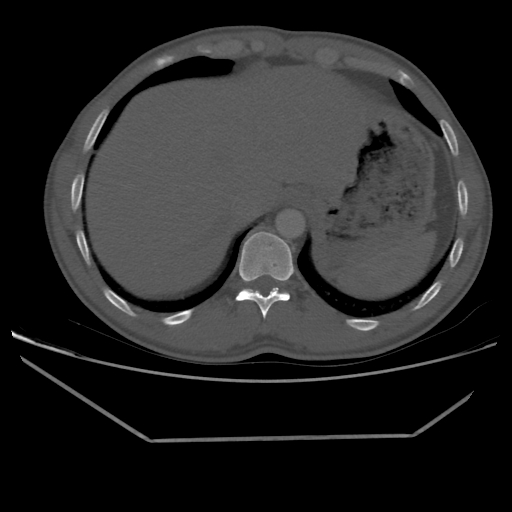 File:Aneurysmal bone cyst - rib (Radiopaedia 82167-96220 Axial bone window 216).jpg