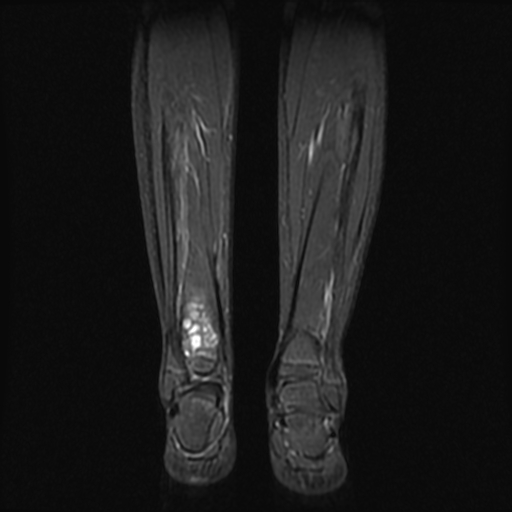 File:Aneurysmal bone cyst - tibia (Radiopaedia 22343-22367 Coronal STIR 12).jpg