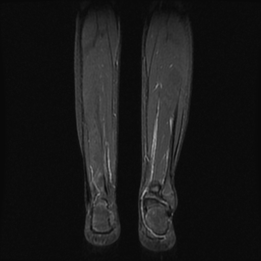 File:Aneurysmal bone cyst - tibia (Radiopaedia 22343-22367 Coronal STIR 14).jpg