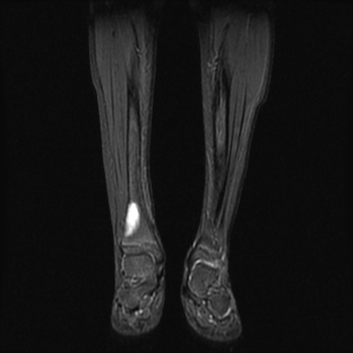 File:Aneurysmal bone cyst - tibia (Radiopaedia 22343-22367 Coronal STIR 7).jpg