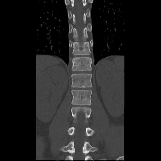 Aneurysmal bone cyst T11 (Radiopaedia 29294-29721 Axial bone window 1).jpg