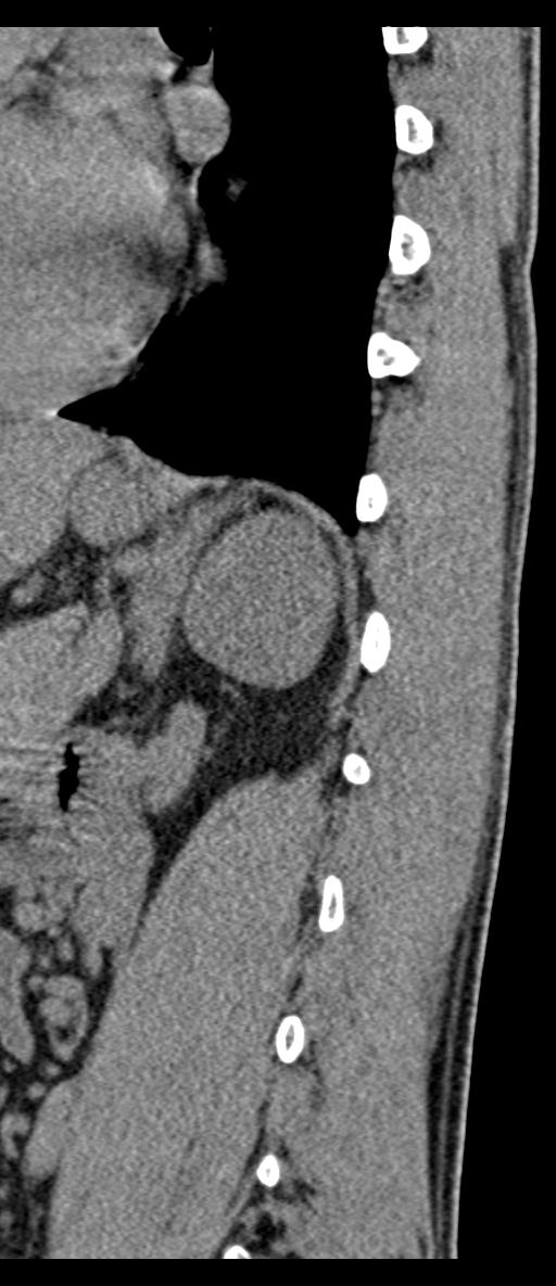 Aneurysmal bone cyst T11 (Radiopaedia 29294-29721 E 17).jpg