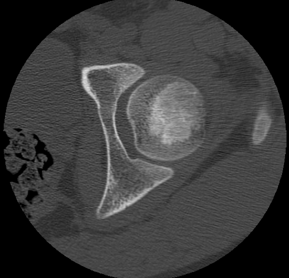 Aneurysmal bone cyst of ischium (Radiopaedia 25957-26094 B 8).png