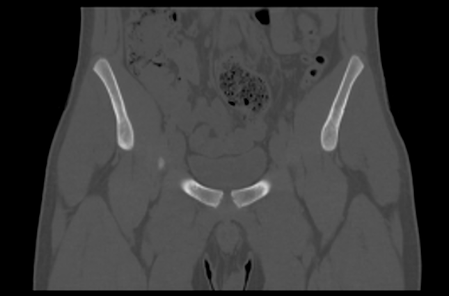 File:Aneurysmal bone cyst of ischium (Radiopaedia 25957-26094 Coronal bone window 10).png