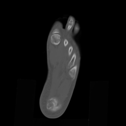 File:Aneurysmal bone cyst of the calcaneus (Radiopaedia 60669-68421 Axial bone window 19).jpg