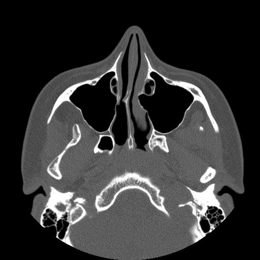 Aneurysmal bone cyst of the mandible (Radiopaedia 43280-46823 Axial bone window 131).jpg