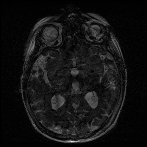 Angioinvasive aspergillosis in the pituitary fossa (Radiopaedia 39676-42010 Ax 3D FIESTA VOLUME 96).png