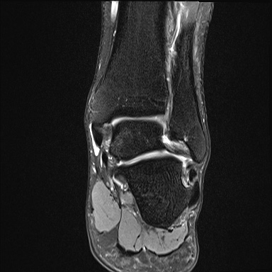 Ankle syndesmotic injury (Radiopaedia 69066-78837 Coronal PD fat sat 26).jpg