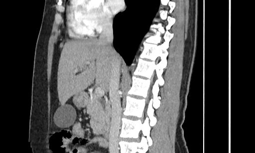 Annular pancreas (Radiopaedia 70359-80453 B 30).jpg
