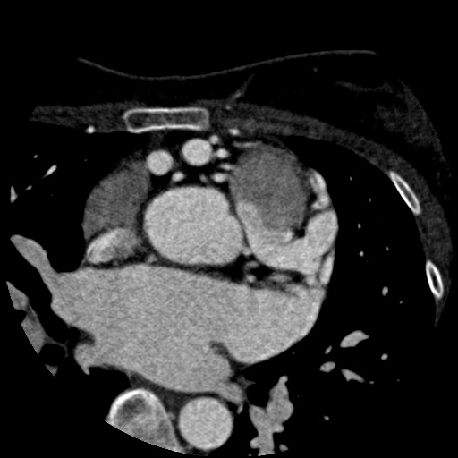 File:Anomalous left coronary artery from the pulmonary artery (ALCAPA) (Radiopaedia 40884-43586 A 18).jpg