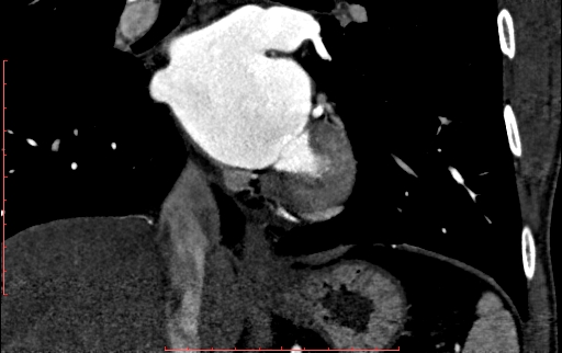 Anomalous left coronary artery from the pulmonary artery (ALCAPA) (Radiopaedia 70148-80181 B 207).jpg