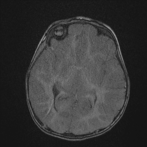 Anoxic brain injury (Radiopaedia 79165-92139 Axial MRA 116).jpg