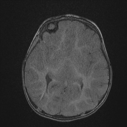 Anoxic brain injury (Radiopaedia 79165-92139 Axial MRA 118).jpg