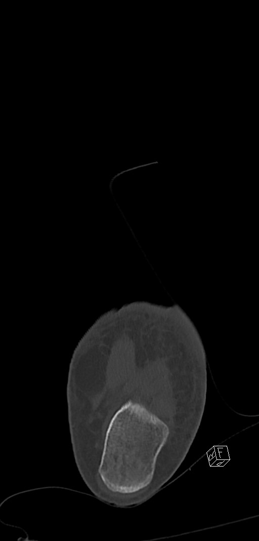 Anterior calcaneal process fracture (Radiopaedia 63353-71943 Coronal bone window 45).jpg