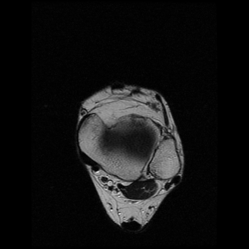 File:Anterior calcaneal process fracture (Radiopaedia 74654-85611 Axial T2 5).jpg