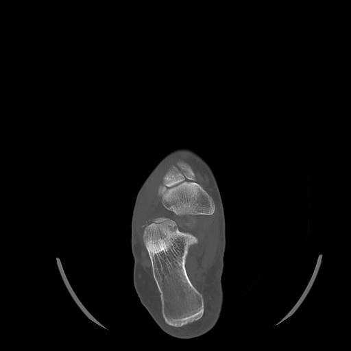 Anterior calcaneal process fracture (Radiopaedia 82590-96762 Axial bone window 23).jpg