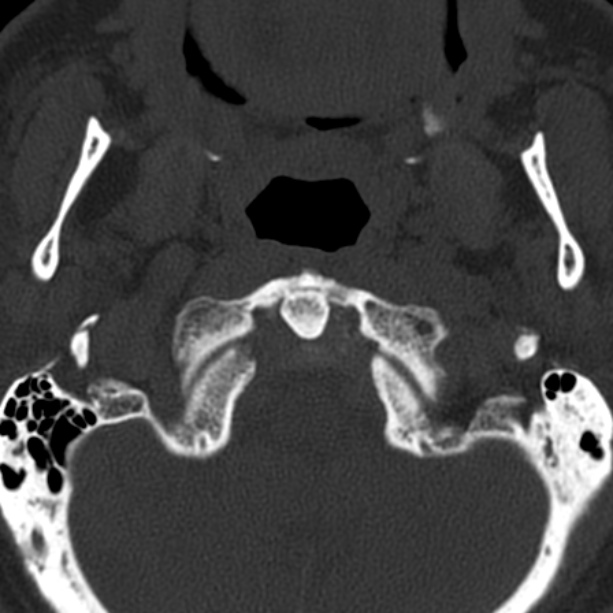 Anterior cervical postdiscectomy arthrodesis (Radiopaedia 32678-33646 Axial bone window 9).jpg