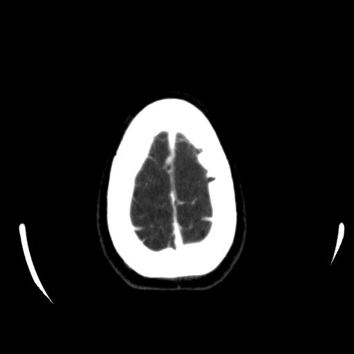 File:Anterior communicating artery aneurysm (Radiopaedia 16633-16335 A 41).jpg
