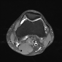 File:Anterior cruciate ligament full thickness tear (Radiopaedia 66268-75467 Axial PD fat sat 9).jpg