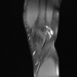 File:Anterior cruciate ligament full thickness tear (Radiopaedia 66268-75467 Sagittal PD fat sat 3).jpg