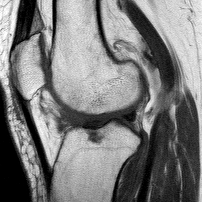 File:Anterior cruciate ligament mucoid degeneration (Radiopaedia 60853-68633 Sagittal T1 47).jpg