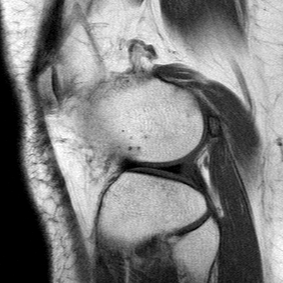 File:Anterior cruciate ligament mucoid degeneration (Radiopaedia 60853-68633 Sagittal T1 51).jpg