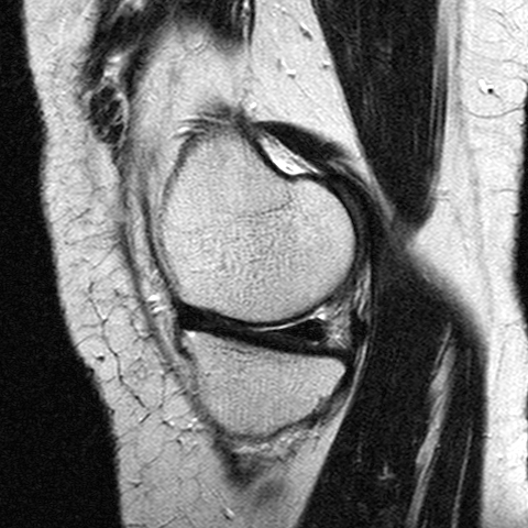 File:Anterior cruciate ligament mucoid degeneration (Radiopaedia 60853-68633 Sagittal T2 10).jpg