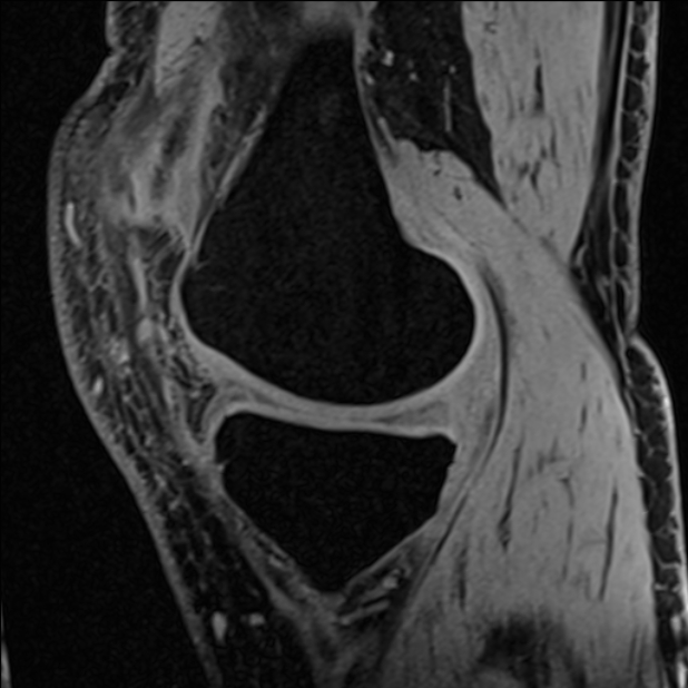 Anterior cruciate ligament tear - ramp lesion (Radiopaedia 71883-82322 Sagittal T1 vibe 96).jpg