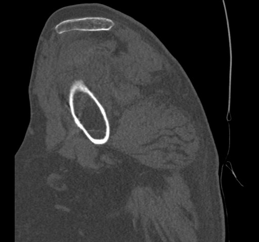 Anterior glenohumeral dislocation with Hill-Sachs lesion (Radiopaedia 62877-71249 Sagittal bone window 24).jpg