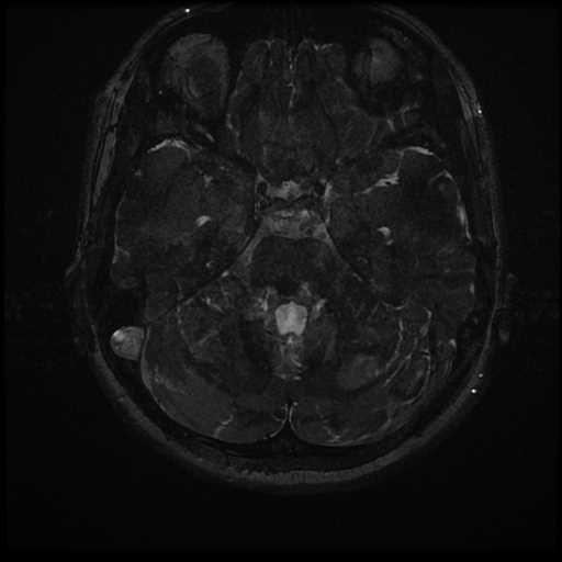 Anterior inferior cerebellar artery vascular loop - type II (Radiopaedia 70991-81209 Axial 3D FIESTA 4).jpg