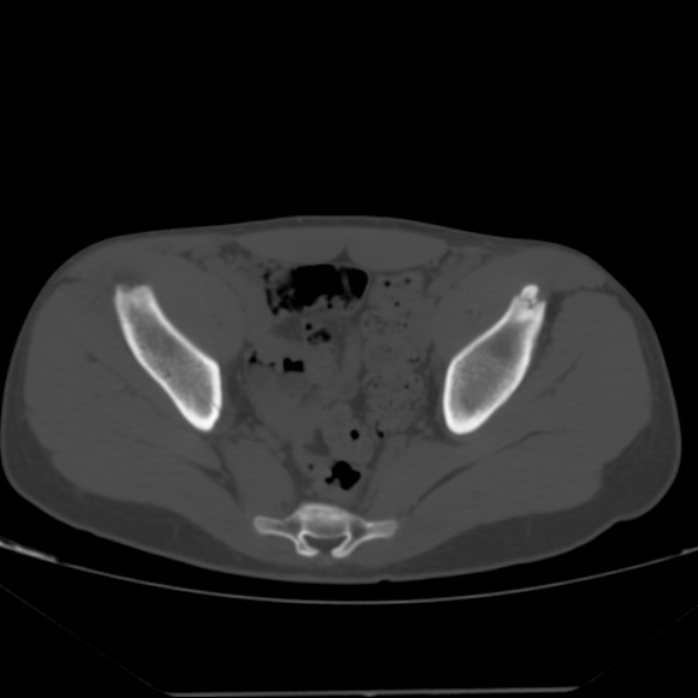 Anterior inferior iliac spine avulsion fracture (Radiopaedia 49469-54627 Axial bone window 27).jpg
