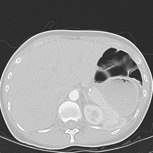 Anterior mediastinal lymphoma (Radiopaedia 29556-30061 Axial lung window 54).jpg