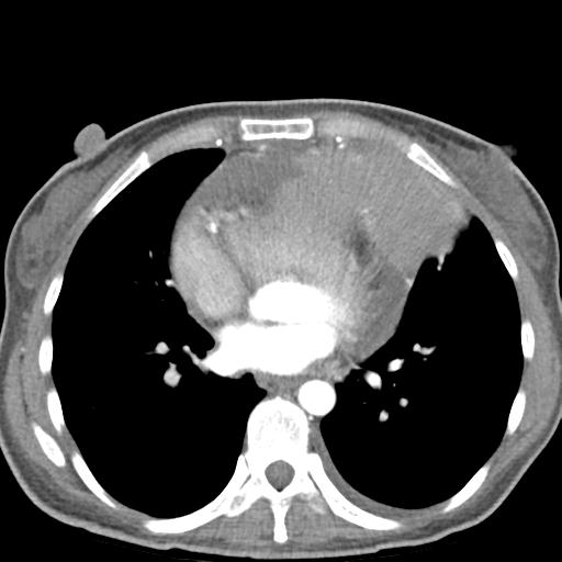 File:Anterior mediastinal lymphoma (Radiopaedia 29556-30061 C 33).jpg
