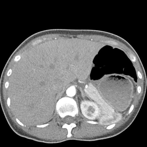 Anterior mediastinal lymphoma (Radiopaedia 29556-30061 C 54).jpg