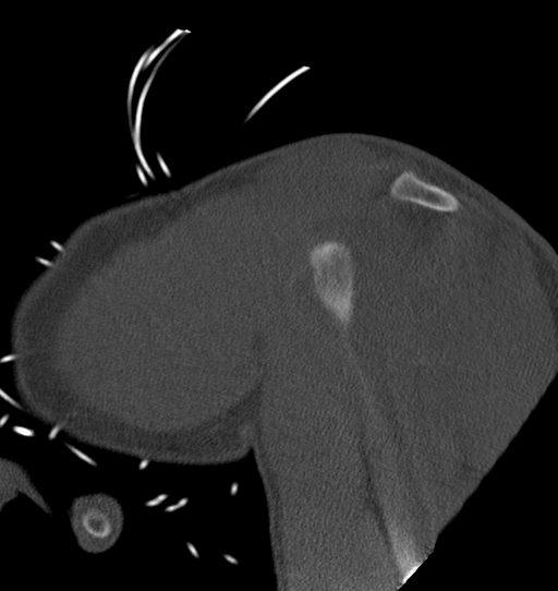Anterior shoulder dislocation with Hill-Sachs and bony Bankart lesions (Radiopaedia 40424-42974 Sagittal bone window 15).png