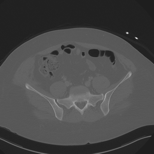 Anterior superior iliac spine avulsion fracture (Radiopaedia 44541-48244 Axial bone window 72).png
