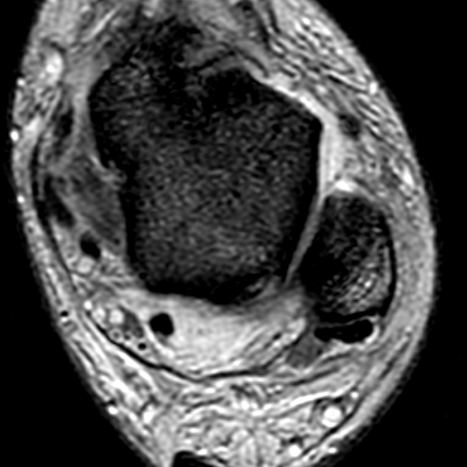 File:Anterior talofibular ligament rupture (Radiopaedia 15831-15484 Axial T2* 10).jpg