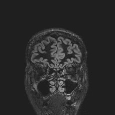 Anterior temporal encephalocele (Radiopaedia 82624-96808 Coronal FLAIR 8).jpg