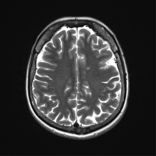 File:Anterior temporal lobe perivascular space (Radiopaedia 40946-43650 Axial T2 27).png