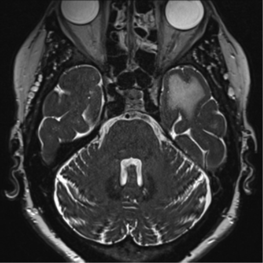 Anterior temporal pole cysts (Radiopaedia 46629-51102 Axial 20).png