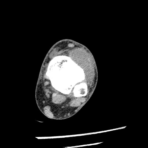 File:Anterior tibial artery false aneurysm (Radiopaedia 88984-105809 A 102).jpg