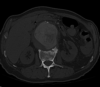 File:Anterior vertebral scalloping (abdominal aortic aneurysm) (Radiopaedia 66744-76067 Axial bone window 18).jpg
