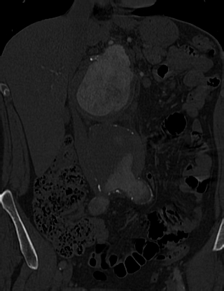 Anterior vertebral scalloping (abdominal aortic aneurysm) (Radiopaedia 66744-76067 Coronal bone window 11).jpg