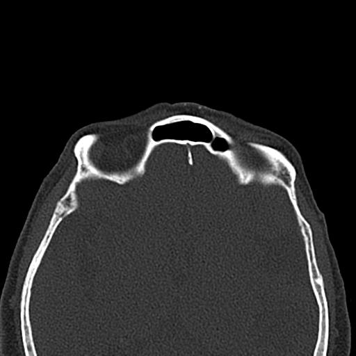 Antral exostoses (Radiopaedia 22371-22396 Axial bone window 43).jpg