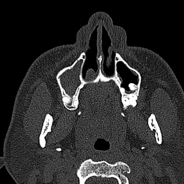 Antrochoanal polyp (Radiopaedia 30002-30554 Axial bone window 13).jpg