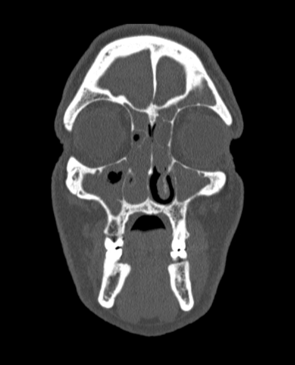 Antrochoanal polyp (Radiopaedia 79011-92169 Coronal bone window 64).jpg